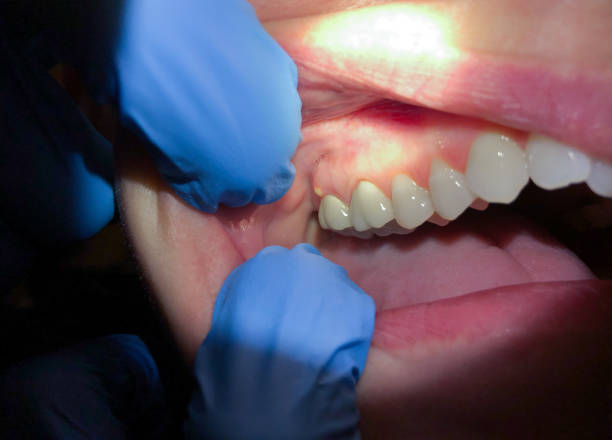Best Emergency Dental Care for Broken or Chipped Teeth in San Antonio Heights, CA